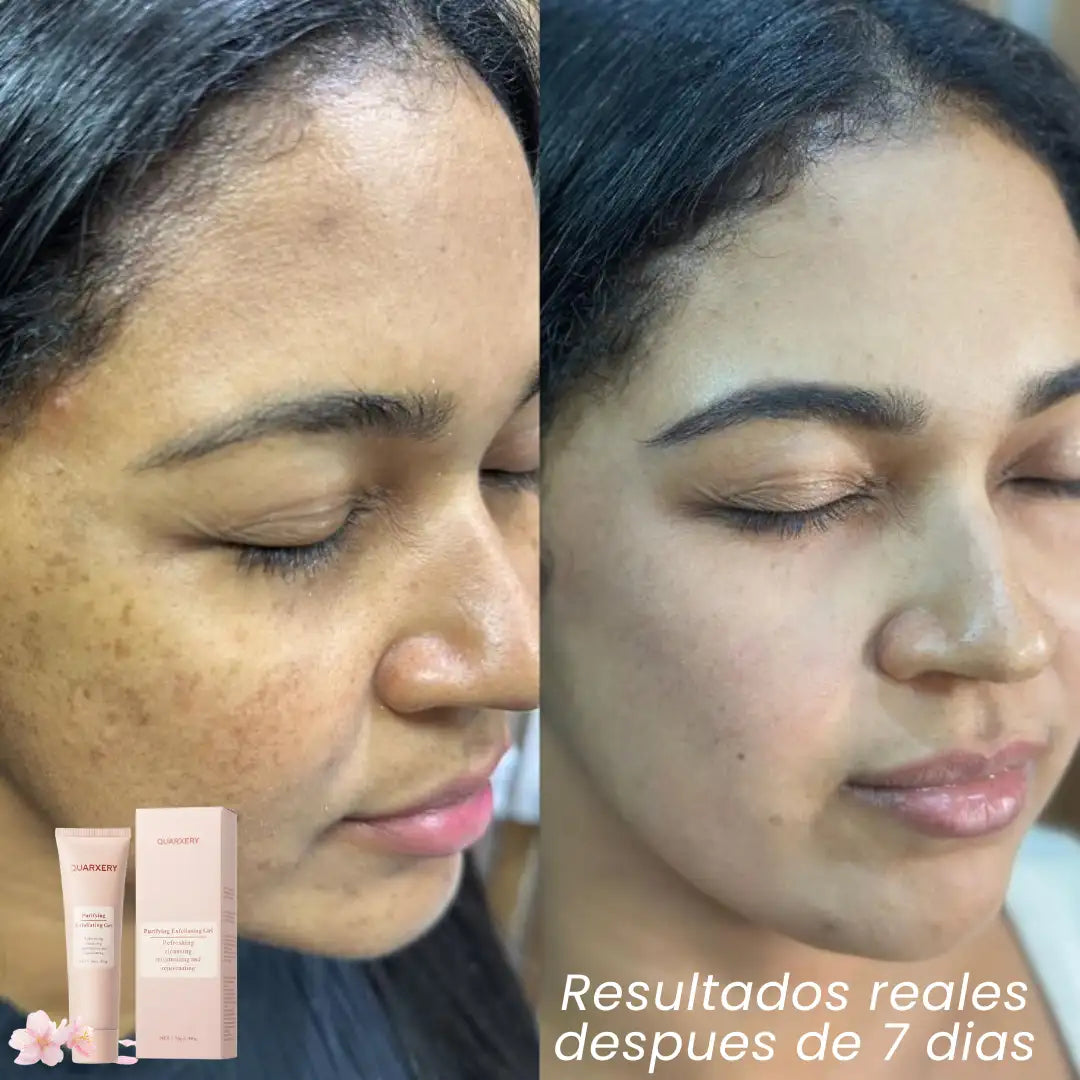 Exfoliante QUARXERY™️| Elimina manchas, puntos negros | Todo tipo de piel